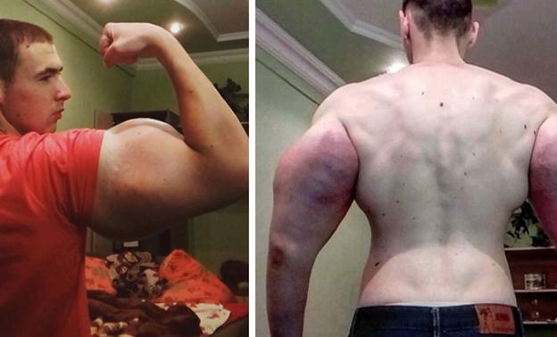Se juega la vida inyectándose synthol en los brazos para tenerlos enormes