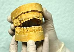 Molde de la dentadura de un paciente con bruxismo. / GONZÁLEZ MOLERO/