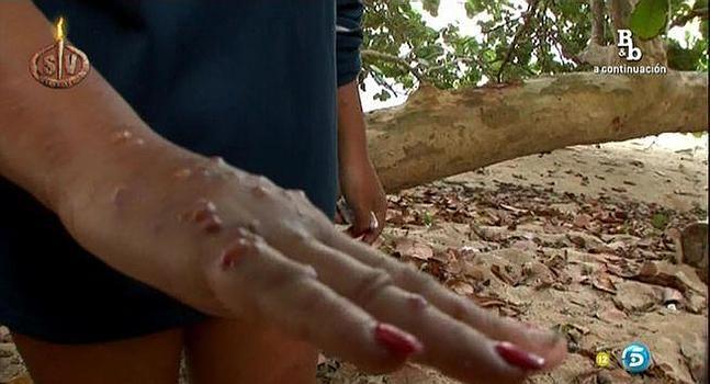 Rebeca, evacuada de Supervivientes tras sufrir ahora 200 picaduras