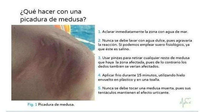 Qu Tienes Que Hacer Si Te Pica Una Medusa Viva Ideal