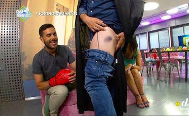 Jordi Martín muestra los presuntos cardenales de la pelea con Bustamante