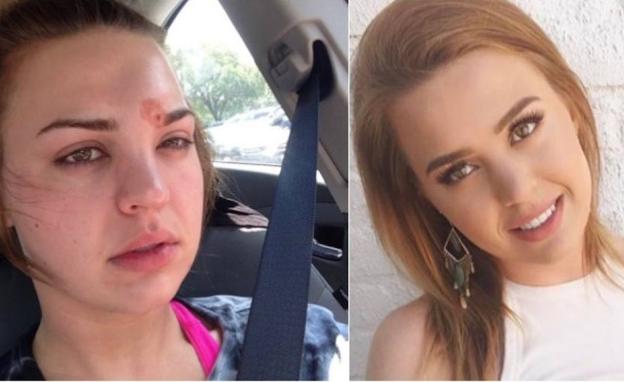 Quitarse una espinilla casi acaba con su vida