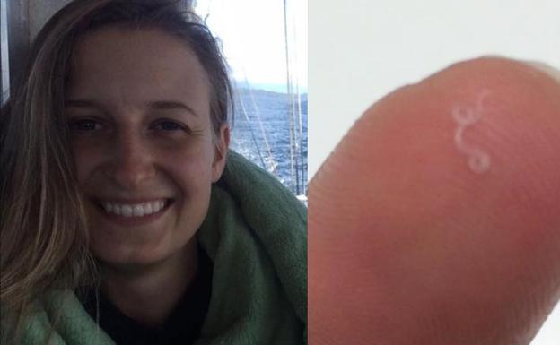 Extraen 14 gusanos del ojo a una mujer infectada por un parásito que afecta a las vacas