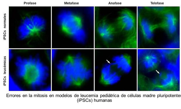 Una donación permite el impulso de una investigación sobre las células madre cancerígenas implicadas en la leucemia infantil