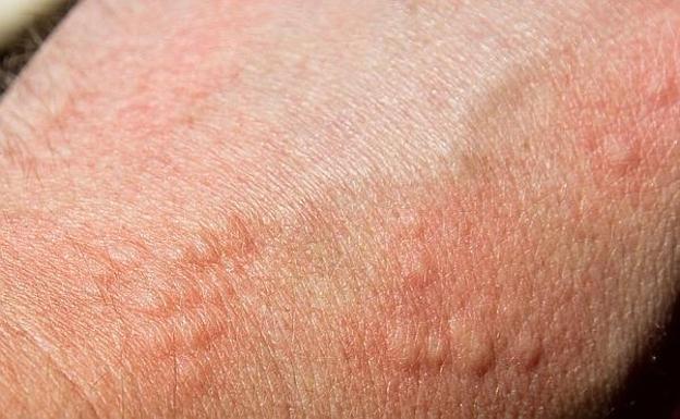 Lo explica una dermatóloga: la urticaria, un problema cada vez más frecuente debido al calor