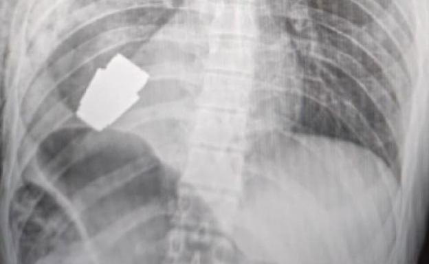 Cirujanos ucranianos extraen una granada del pecho de un soldado