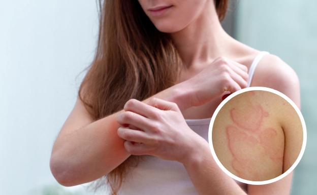 Alergia al frío: causas, síntomas y tratamientos