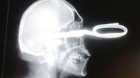 Le clavan unas tijeras en la cabeza y llega a Urgencias andando: "Tengo un pequeño problema"