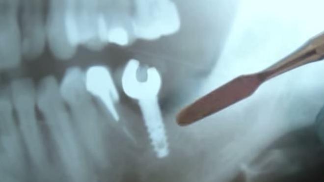 'Crean' un implante para abrir cervezas con los dientes