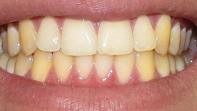 Por qué los dientes se vuelven amarillos aunque te los laves bien? | Ideal