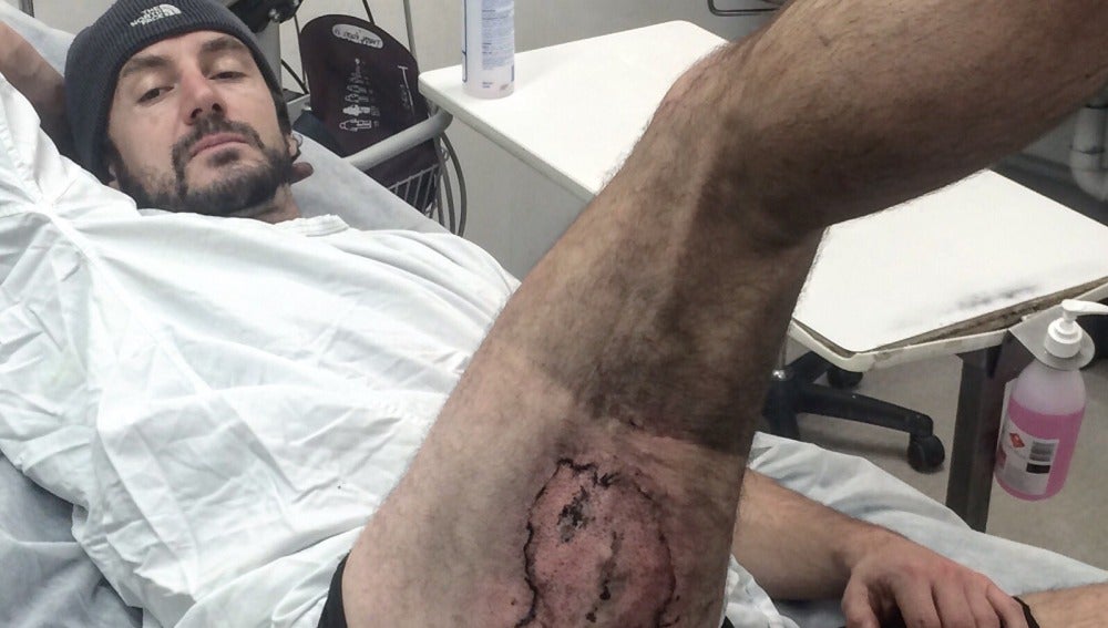 Así se le quedó el muslo tras explotarle su nuevo iPhone en el bolsillo