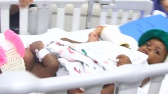 Separan con éxito a dos siamesas de 1 año unidas por la cadera